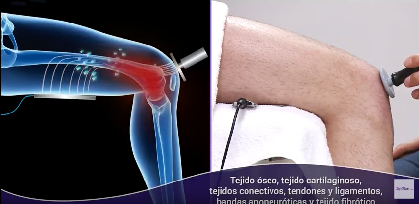 Tecarterapia hipertemia profunda Electroestimulación y Terapia