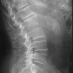 columna_lumbosacra_lordosis_corta